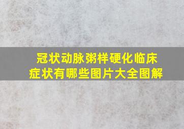 冠状动脉粥样硬化临床症状有哪些图片大全图解