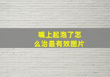 嘴上起泡了怎么治最有效图片