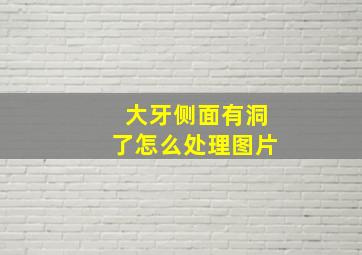 大牙侧面有洞了怎么处理图片