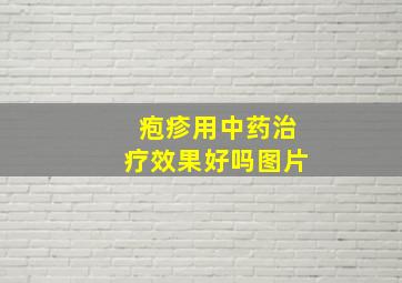 疱疹用中药治疗效果好吗图片