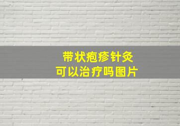 带状疱疹针灸可以治疗吗图片