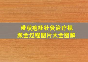 带状疱疹针灸治疗视频全过程图片大全图解