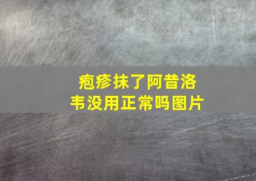 疱疹抹了阿昔洛韦没用正常吗图片